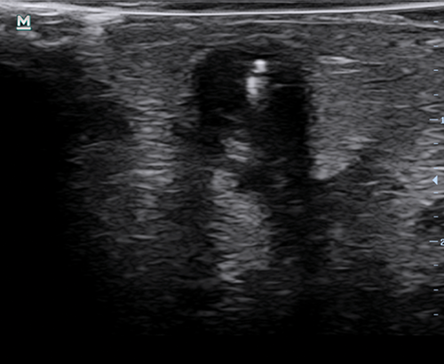 Transverse ultrasound image of a needle being used to access a humacyte graft 