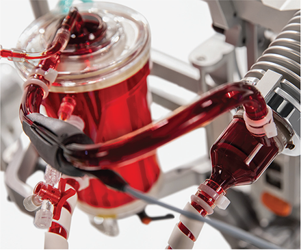 Novalung ECMO system pumps and oxygenates a patient’s blood 